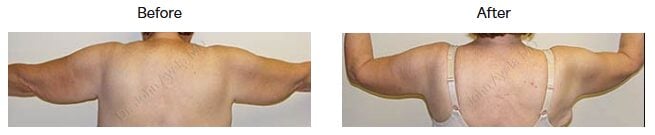 Before and after arm lift showing improved upper arm contour
