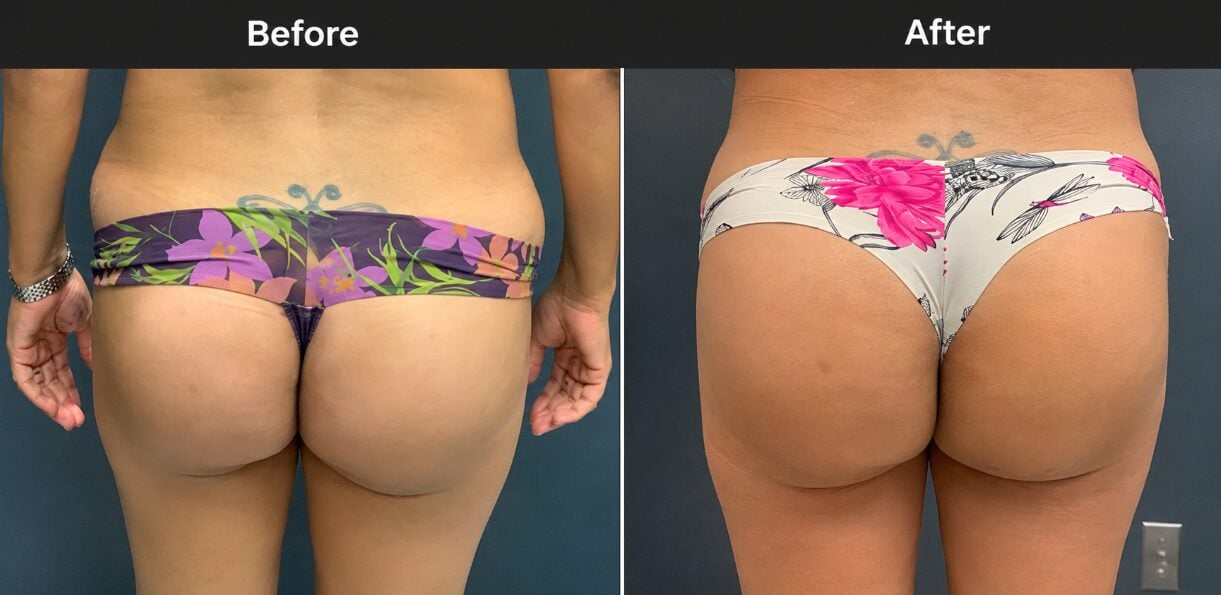 Before and after Brazilian Butt Lift in San Antonio