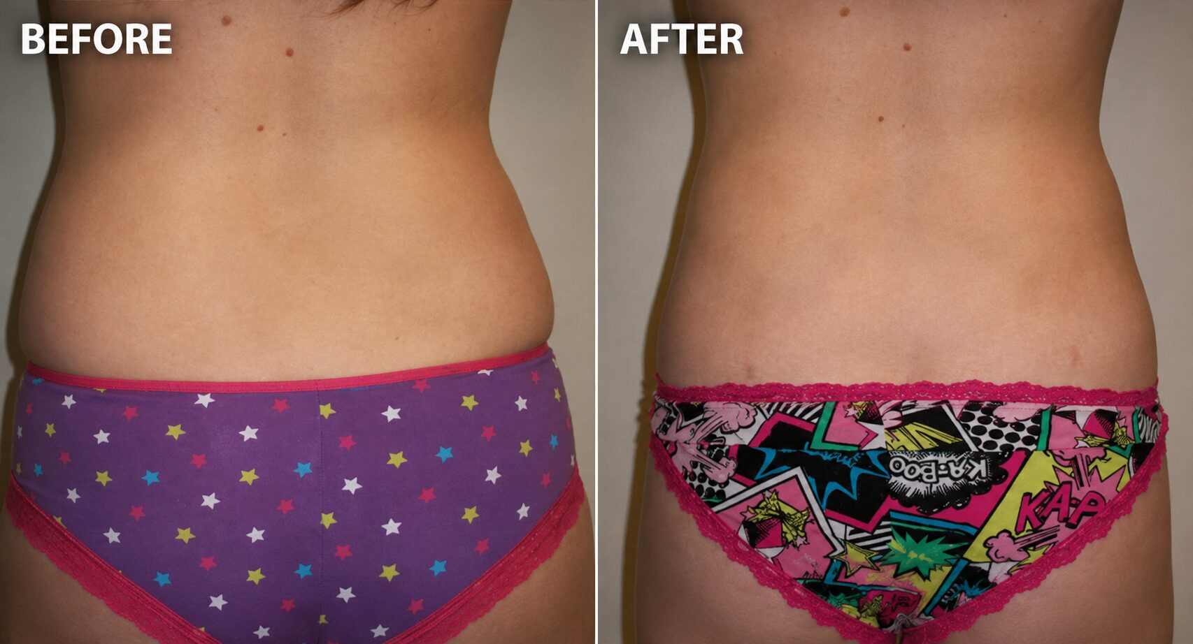 Before and after liposuction of the flanks