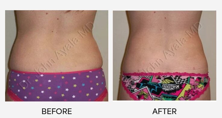 Before and after liposuction in San Antonio