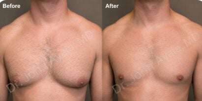 Before and after male breast reduction in San Antonio