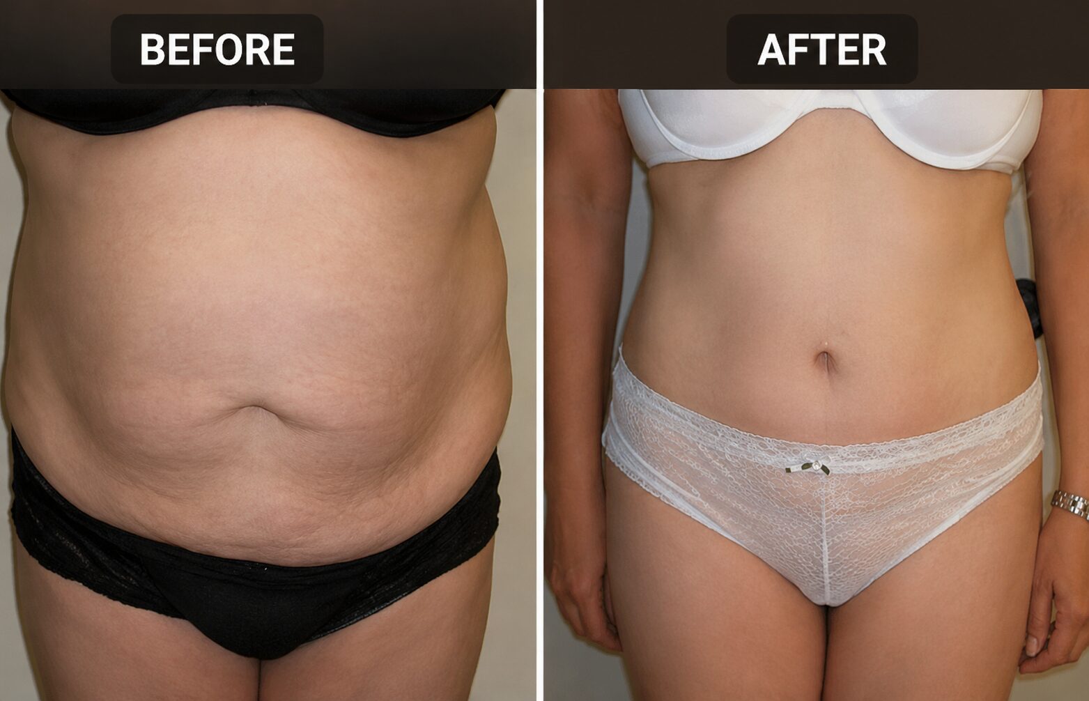 Before and after tummy tuck surgery in San Antonio
