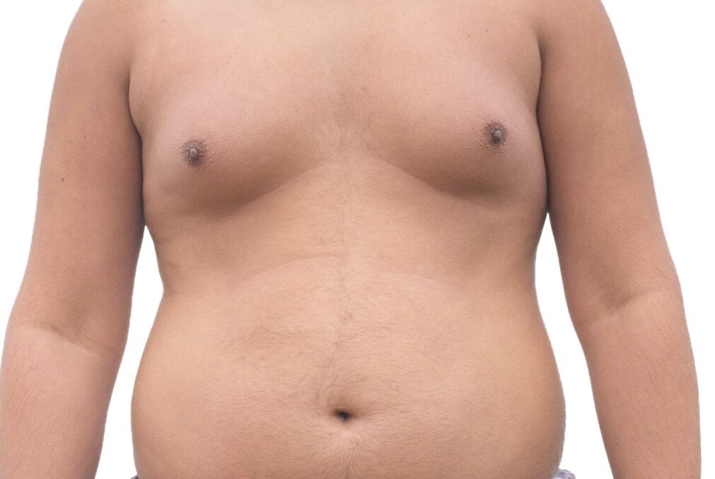 Chest showing glandular breast tissue enlargement characteristic of gynecomastia