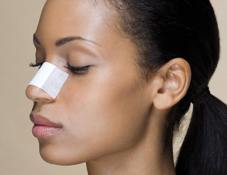 Nasal splint taped in place during recovery from revision rhinoplasty
